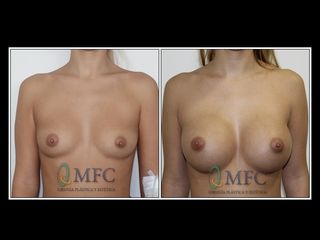 Antes y después Aumento de pecho implantes anatómicos