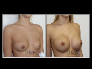 Antes y después Aumento de pecho implantes anatómicos