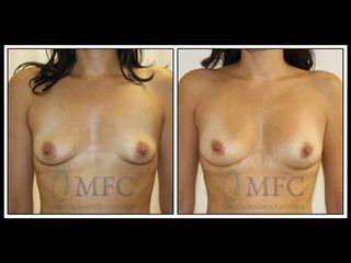 Antes y después Lipofilling mamario
