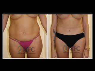 Antes y después Abdoinoplastia y liposucción