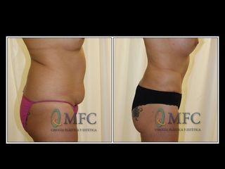 Antes y después Abdominoplastia y liposucción