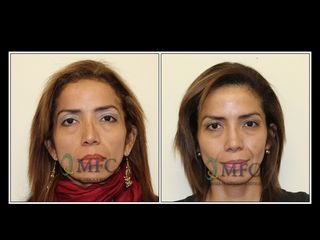 Antes y después Rinoplastia secundaria
