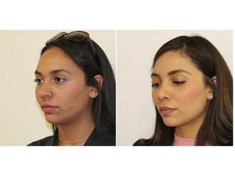 Rinoseptoplastia - 629466