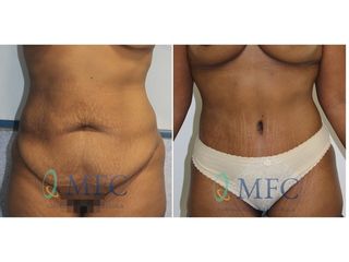 Antes y después abdominoplastia con liposuccion