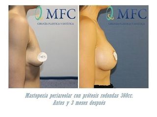 Antes y después Mastopexia