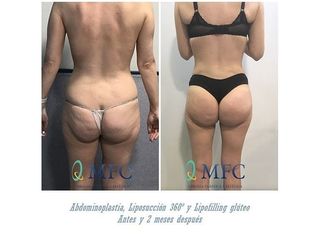 Antes y después Liposucción