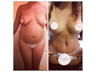 Antes y después Abdominoplastia