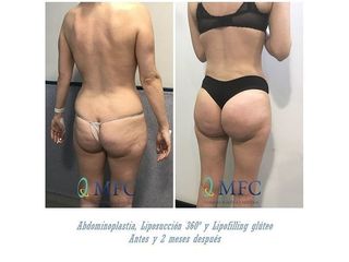 Antes y después Gluteoplastia