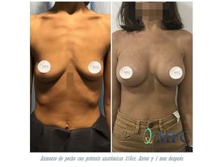Antes y después Aumento de pecho