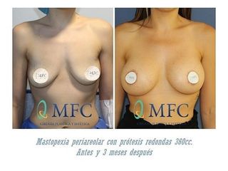 Antes y después Mastopexia
