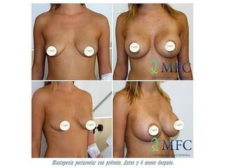 Antes y después Mastopexia