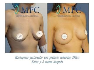Antes y después Mastopexia