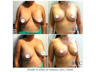Antes y después Mastopexia