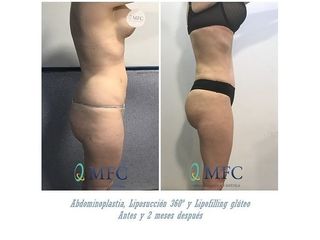 Antes y después Abdominoplastia