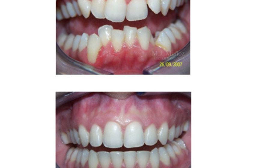 Implantes dentales antes y después - 663925