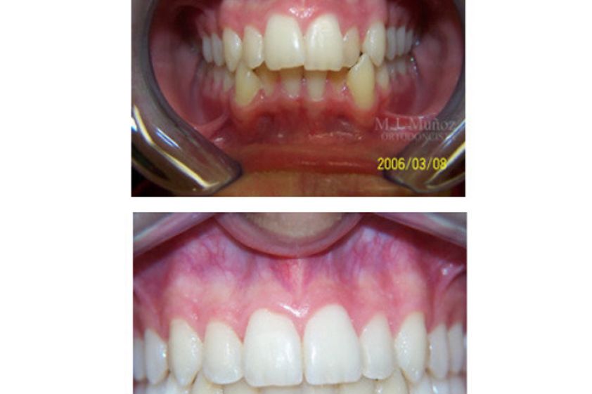 Implantes dentales antes y después - 663927