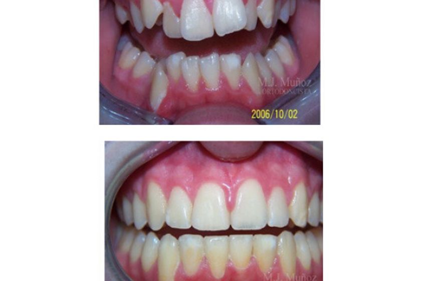 Implantes dentales antes y después - 663928