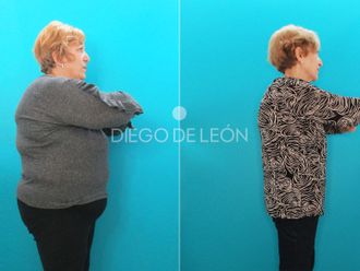 Tratamiento obesidad antes y después - 872432