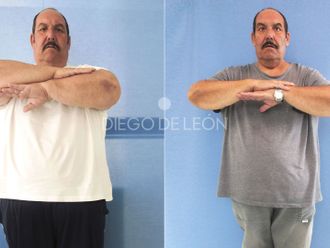 Tratamiento obesidad antes y después - 872433