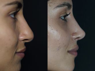 Rinoplastia antes y después - 876377