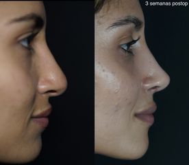 Rinoplastia - Dr. Ramón Cobo
