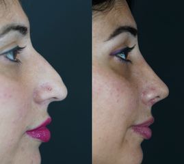 Rinoplastia - Dr. Ramón Cobo