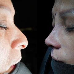 Rinoplastia - Dr. Ramón Cobo