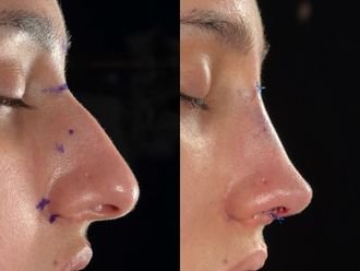 Rinoplastia antes y después - 876382