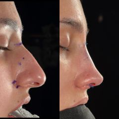 Rinoplastia - Dr. Ramón Cobo