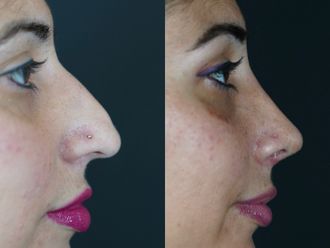 Rinoplastia antes y después - 876383