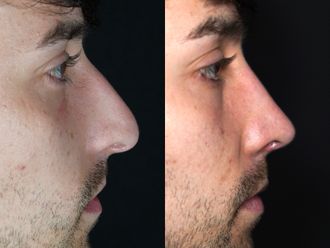 Rinoplastia antes y después - 876384