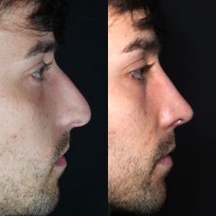 Rinoplastia - Dr. Ramón Cobo