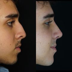 Rinoplastia - Dr. Ramón Cobo