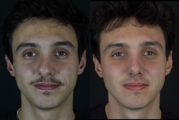 Rinoplastia - Dr. Ramón Cobo