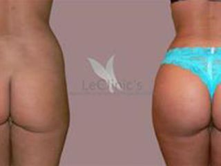 antes y despues lipo