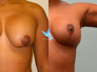 Contractura capsular