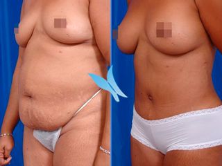 Abdominoplastia