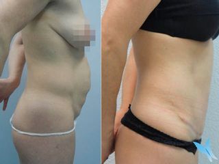 Abdominoplastia