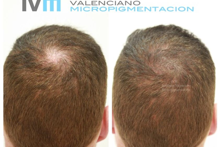 Micropigmentación antes y después - 514201