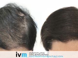 Antes y después Tratamiento Alopecia mediante técnica de Tricopigmentación