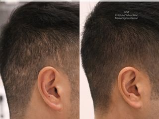 Antes y después Camuflaje de cicatrices mediante técnica de tricopigmentación