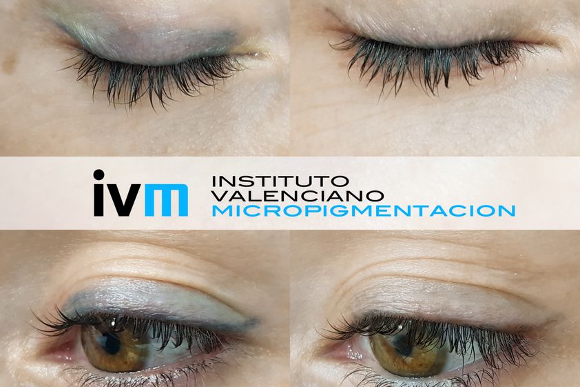 Eliminación de tatuajes antes y después - 648933