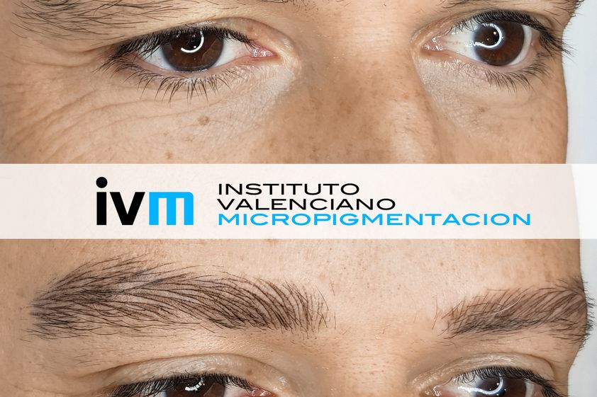 Alopecia antes y después - 649273