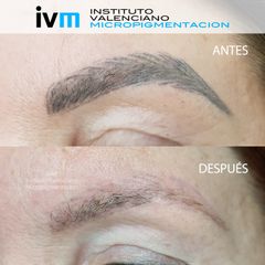 Eliminación de micropigmentación - Instituto Valenciano Micropigmentación