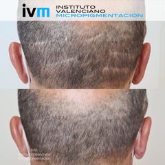 Tricopigmentación - Instituto Valenciano Micropigmentación