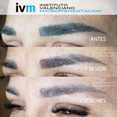 Eliminación de micropigmentación - Instituto Valenciano Micropigmentación