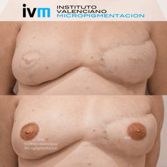 Micropigmentación areolas - Instituto Valenciano Micropigmentación