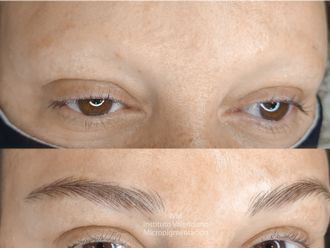 Alopecia - 791711