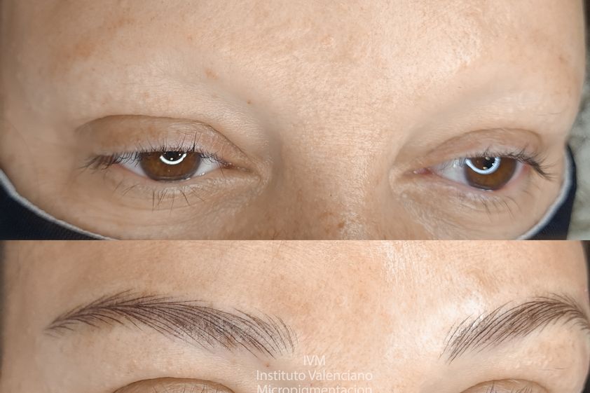 Alopecia antes y después - 791711