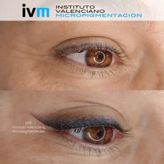 Micropigmentación - Instituto Valenciano Micropigmentación